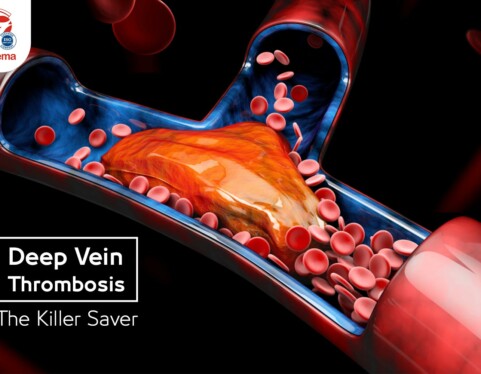 Deep Vein Thrombosis, The Killer Saver