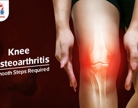 Knee Osteoarthritis, Smooth Steps Required